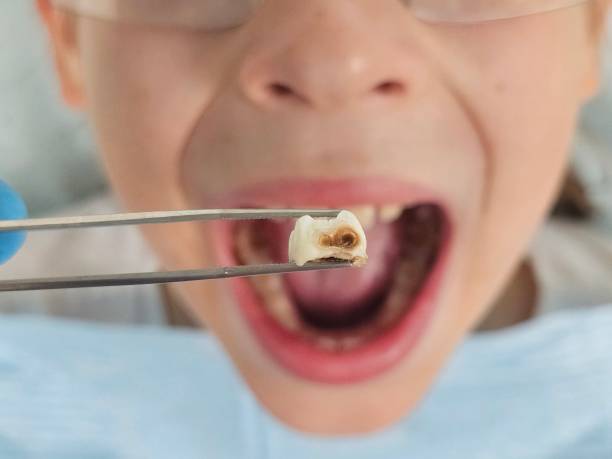Best Emergency Treatment for Dental Infections or Abscesses in Columbiana, OH