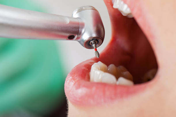 Best Emergency Root Canal Treatment in Columbiana, OH